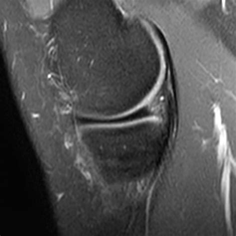 Bucket-handle Tear of the Meniscus - Radsource