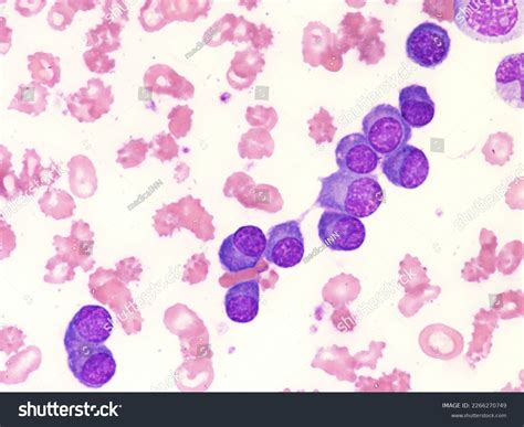 Plasma Cell Leukemia