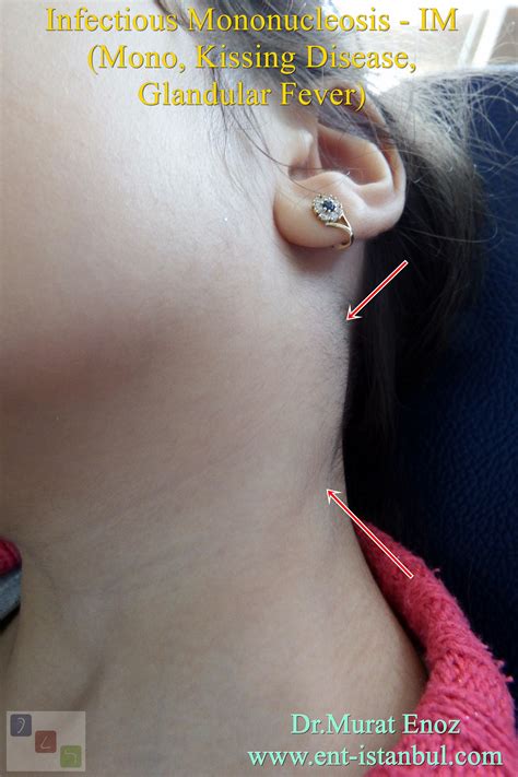 Infectious Mononucleosis (Mono, Kissing Disease, Glandular Fever)