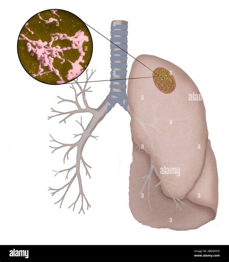 Mycoplasma bacteria hi-res stock photography and images - Alamy