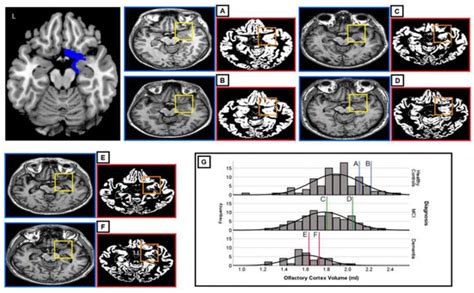 Alterations in Olfactory Cortex Volume in Mild Cognitive Impairment and ...
