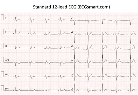 Online Interpretation of 12-Lead Standard ECG