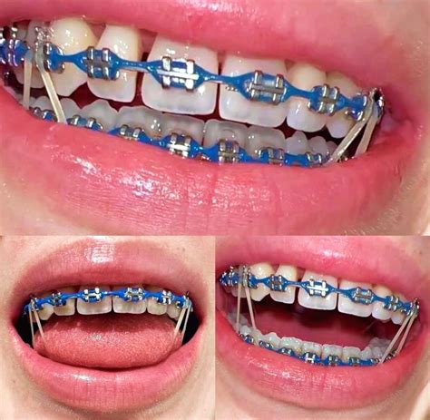 11 blue braces combinations to match every taste – Artofit