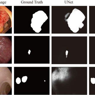 Image result for Colonoscopy Polyps