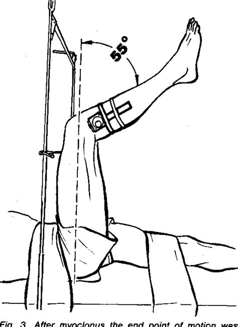 Medial Hamstring Reflex Test 的图像结果