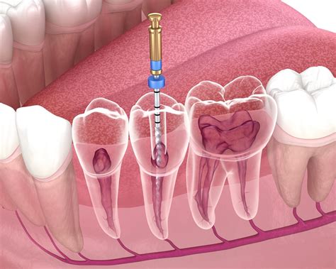 What Is Endodontics