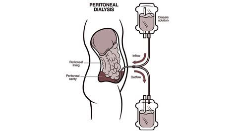 Peritoneal Dialysis Catheter