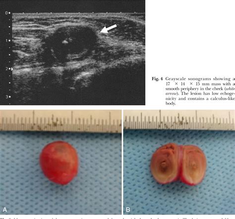 Figure 1 from A phlebolith in the anterior portion of the masseter ...