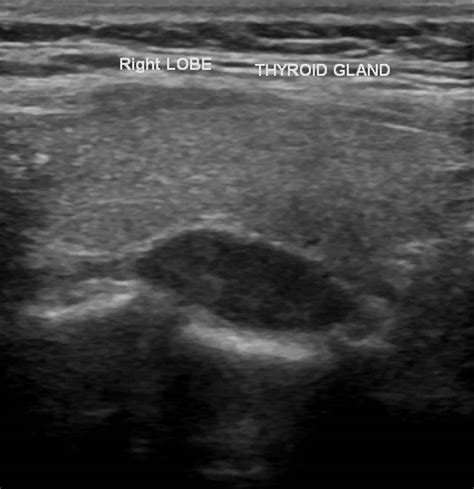 Parathyroid Ultrasound
