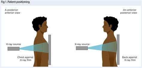 How to interpret chest radiographs (X-rays): a systematic approach ...