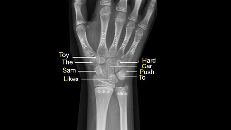 X Ray Hand Bones