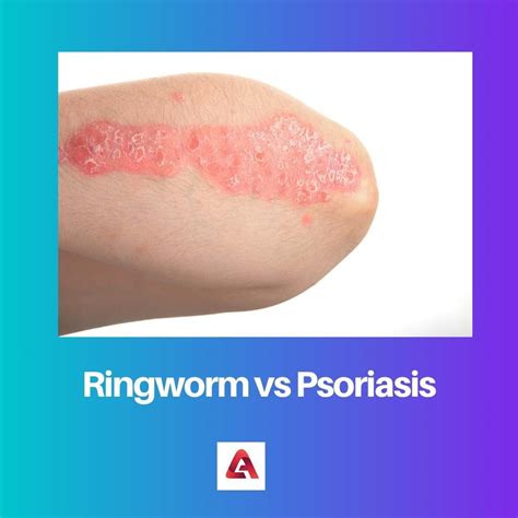 Plaque Psoriasis Vs Ringworm at Otto Atkinson blog