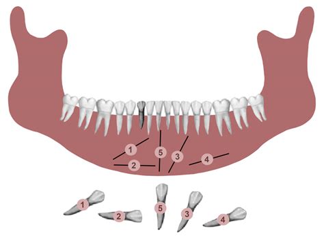 Impacted Permanent Mandibular Canines: Epidemiological Evaluation