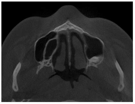 The CBCT Retrospective Study on Underwood Septa and Their Related ...