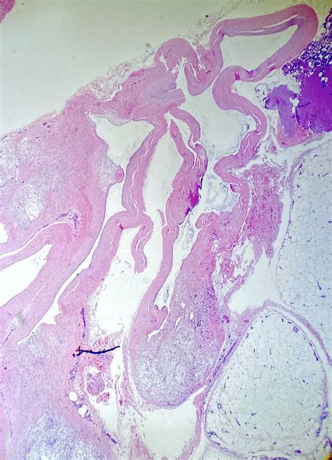 Baker Cyst Knee Pathology Outlines at Rachel Stearn blog