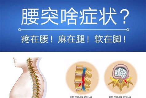 针灸师Jim Liu独创疗法治好腰椎间盘突出（内突） （案例0053） - YouTube