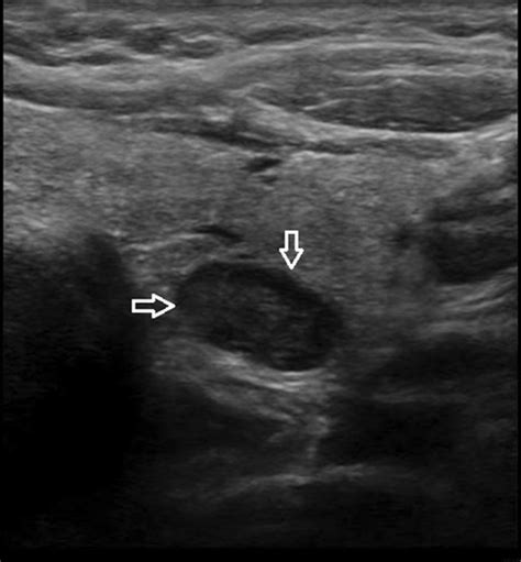 Parathyroid Tumor Ultrasound