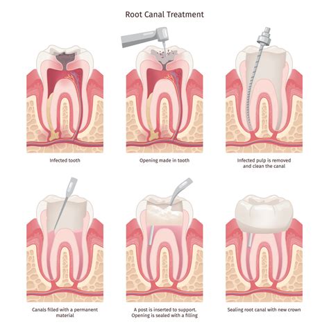 Does A Root Canal Hurt