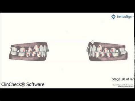 Invisalign Animation 的图像结果