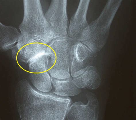 Understanding STT Arthritis: Symptoms and Treatment - Sport Doctor London