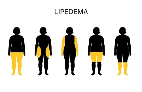¿Qué es el Lipedema? - Clínica Bruselas