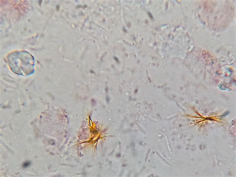 Bilirubin Crystals In Urine