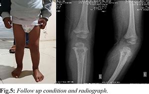 Infantile Tuberculous Osteomyelitis of the Proximal Tibia