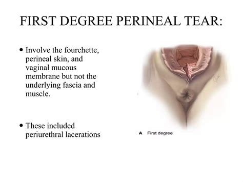 presentaion on perineal tear | PPTX