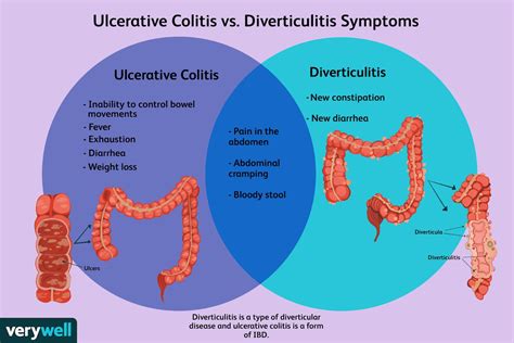 Colitis Vs. Cancer 的图像结果