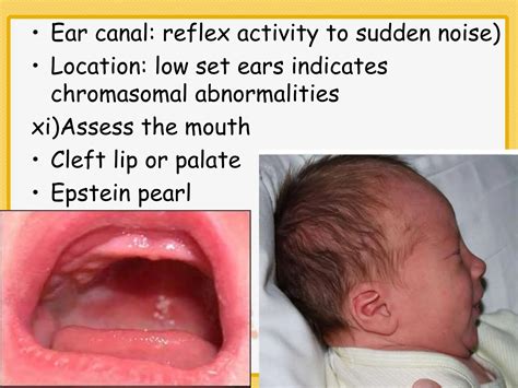 Epstein Pearls Newborn