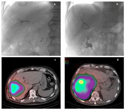 Balloon-Occluded Hepatic Radioembolization with Yttrium-90 (b-TARE) in ...
