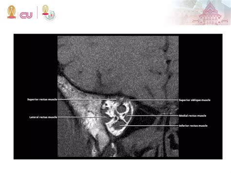 Anatomy of Orbit and Lacrimal system | PDF