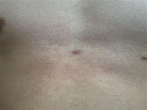 Hard lump on chest. What is this? : r/Hair