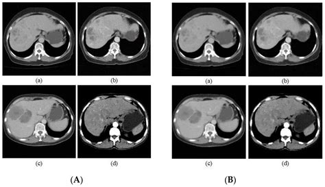 Liver CT Image Recognition Method Based on Capsule Network