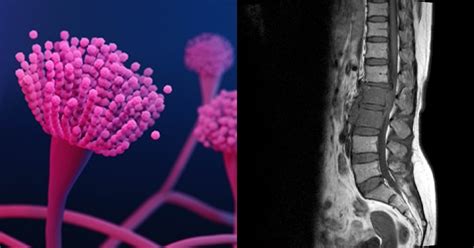 After Mucormycosis, A Rare Fungal Infection Affecting The Spine ...