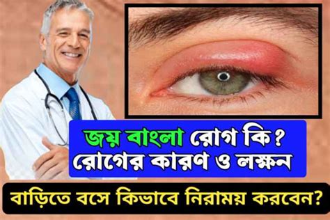 জয় বাংলা রোগ বা কনজাংটিভাইটিস রোগ কি, রোগের কারণ, লক্ষণ ও এবং বাড়িতে ...