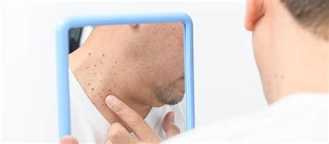 Este Es El Significado De Las Verrugas En El Cuello Bioguia