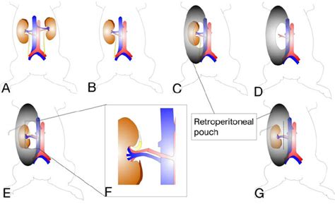 Image result for Open Nephrectomy Procedure