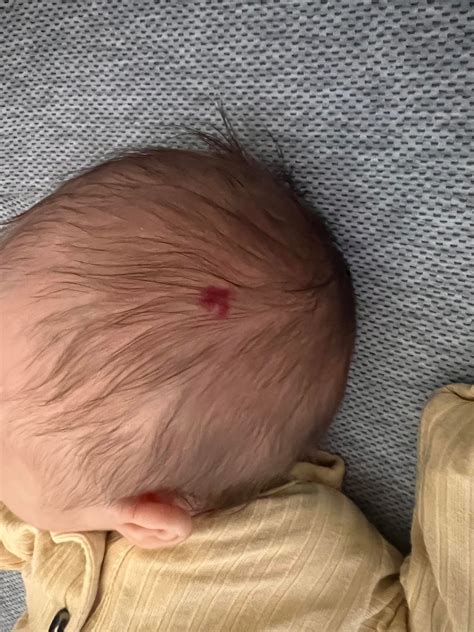 Red spot on head?? : r/newborns