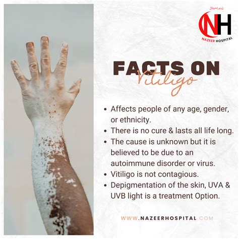 World Vitiligo Day: Causes and Symptoms - Nazeer Hospital