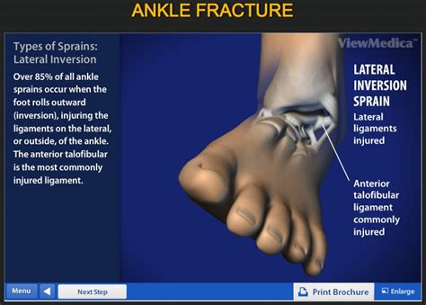 Best 25+ Ankle fracture ideas on Pinterest | Ankle sprain grades ...