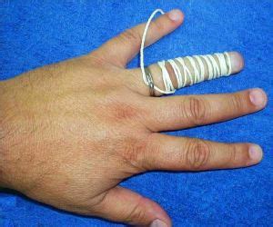 Image result for Ring Removal String Technique