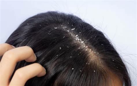 Can dandruff cause acne? - Cause & Treatment of Acne due to Dandruff
