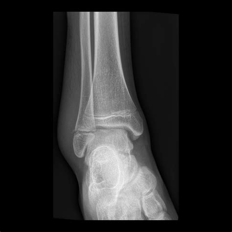 Salter-Harris Fracture | Pediatric Radiology Reference Article | Pediatric Imaging | @pedsimaging
