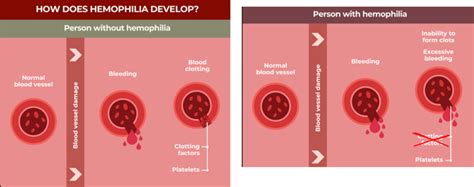 Gene therapy for Haemopholia