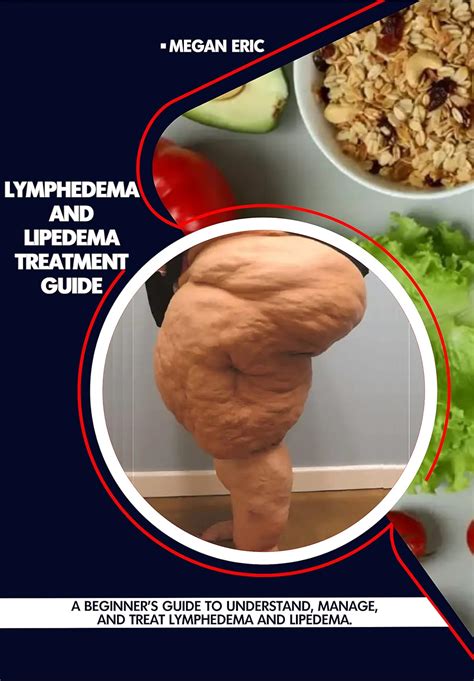 Lymphedema and Lipedema Treatment Guide: A Beginner's Guide to ...