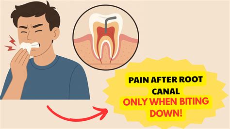 My tooth after a root canal hurts when I chew or press on it