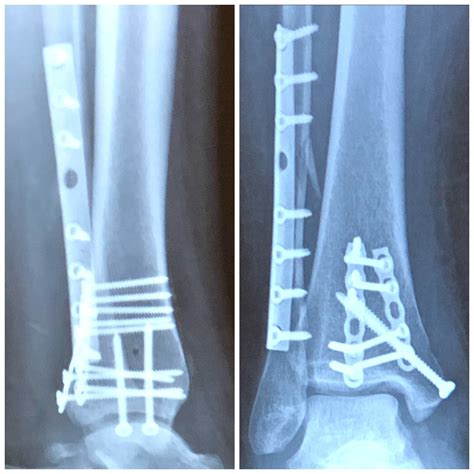 Lateral Malleolus Fracture Recovery Time