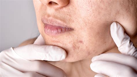 How to treat hormonal acne with ageing skin? – Suganda Skincare