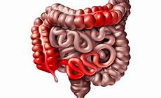alimenti per colite ulcerosa malattia di crohn e colite ulcerosa quello non si osa alimenti per colite ulcerosa malattia di crohn e colite ulcerosa quello non si osa